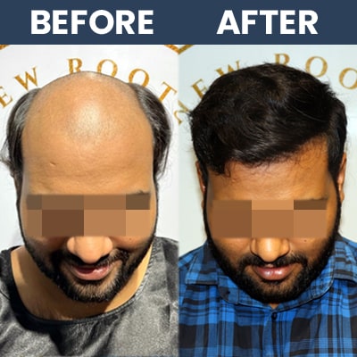 Hair Transplant