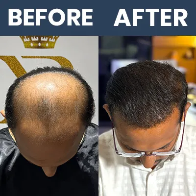 Hair Transplant