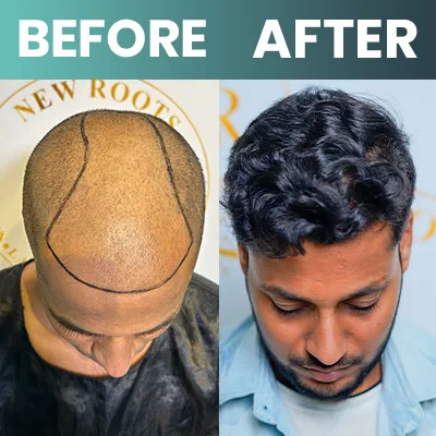 Hair Transplant