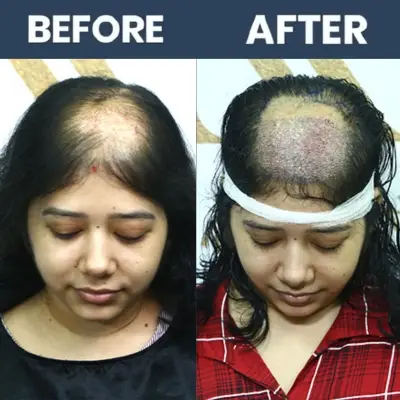 No Shave Hair Transplant