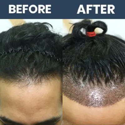 No Shave Hair Transplant